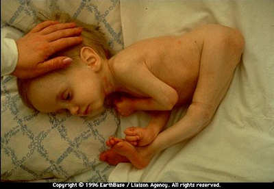 Birth defects and deaths continue from the Three Mile Island and the Chernobyl disasters